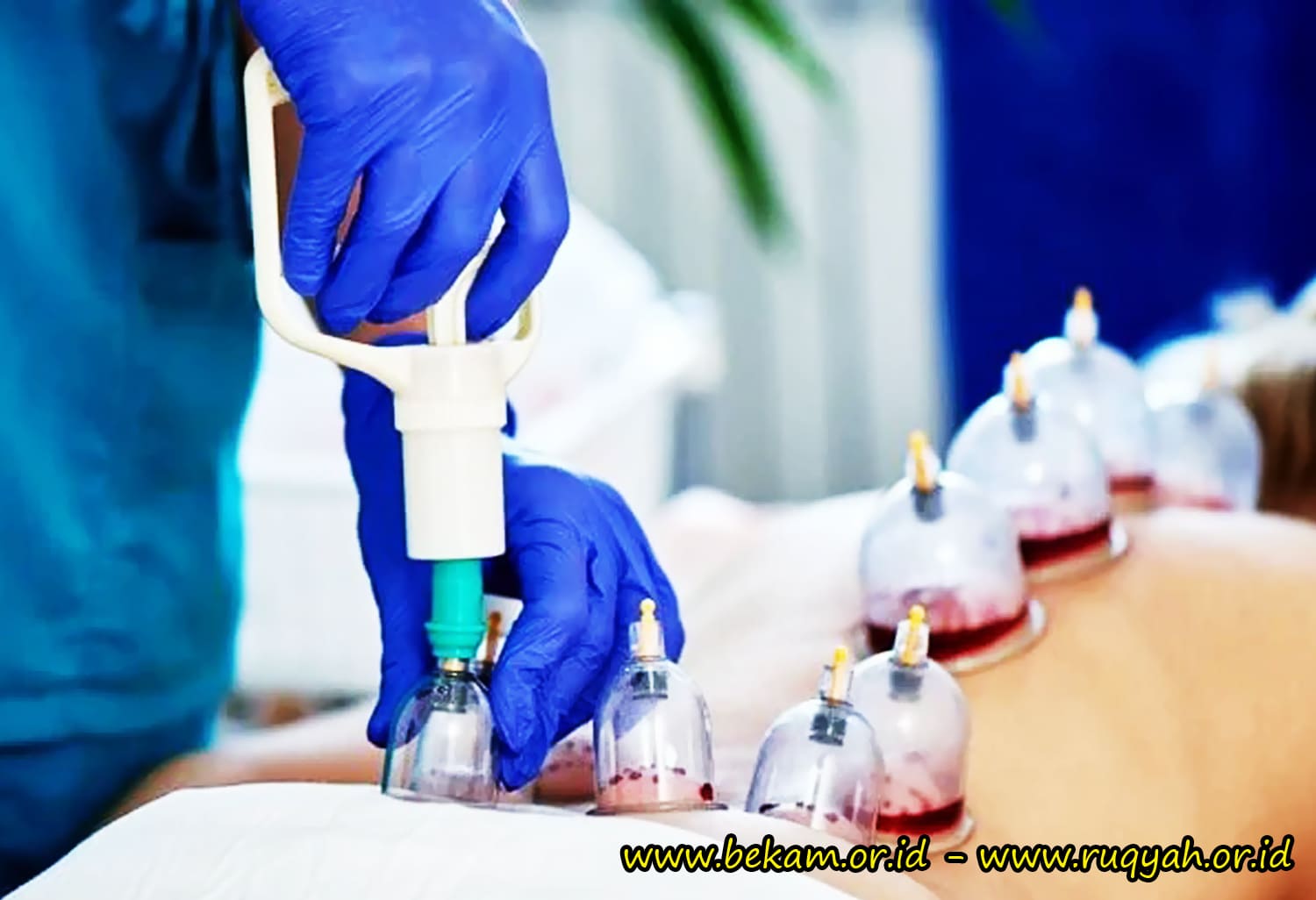 Bekam Batam Sangat Efektif untuk Pengobatan Asam Urat, Diabetes, Ginjal dan Jantung