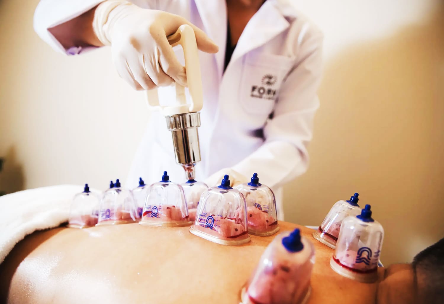 Bekam Sunnah, Manfaat, Proses, dan Dalil dari Rasulullah 