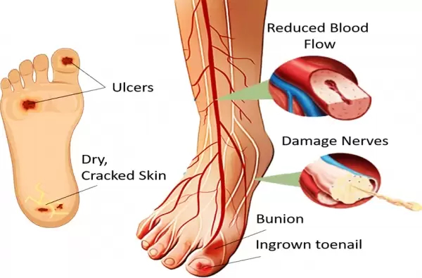 Kondisi kaki akibat terserang diabetes