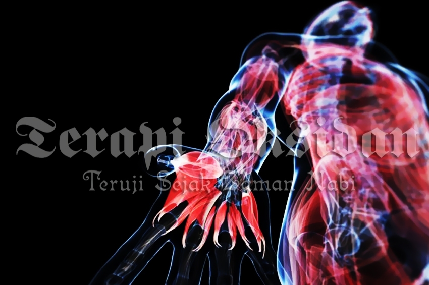 Menggapai Sehat yang Baik dengan Bekam